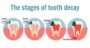 What Are The Symptoms Of Tooth Decay