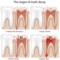 What Are Causes Of Tooth Decay
